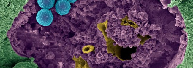 células-tronco do sangue (azul) são eliminadas da medula óssea (roxa) antes que novas células-tronco possam ser transplantadas.