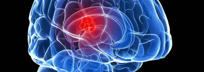 gliobastoma in brain